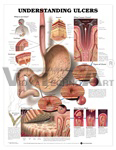 Understanding Ulcers Anatomical Chart